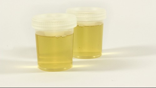 Te advierte sobre los cálculos renales: Estos son los cambios en la orina a los que deberías estar atento