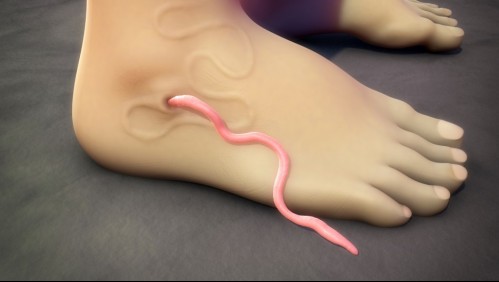 Dracunculosis: La infección parasitaria que solo se puede eliminar del cuerpo si es que tiras de la lombriz