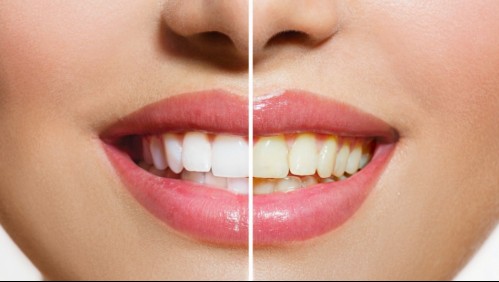 Esta es la técnica de un dentista para reconocer si tus dientes se han puesto muy amarillos
