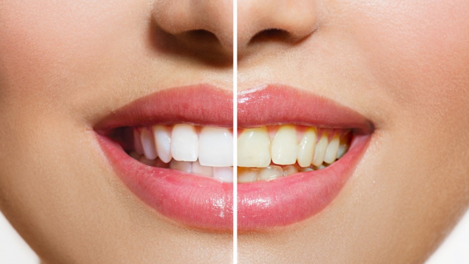 color-dientes color dientes