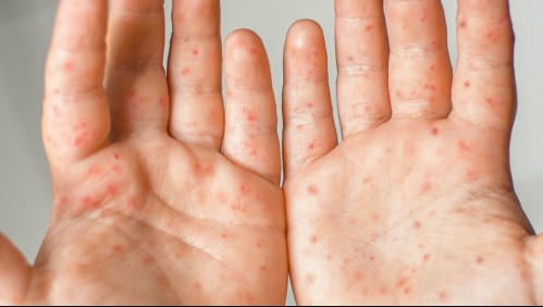 Virus Coxsackie: Estas son las señales de la contagiosa enfermedad que afecta a los niños