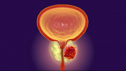 ¿Problemas para orinar? 8 síntomas que advierten el cáncer de próstata
