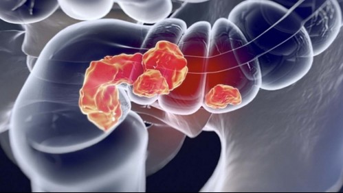 6 cambios en el cuerpo que podrían indicar la presencia de cáncer en el colon
