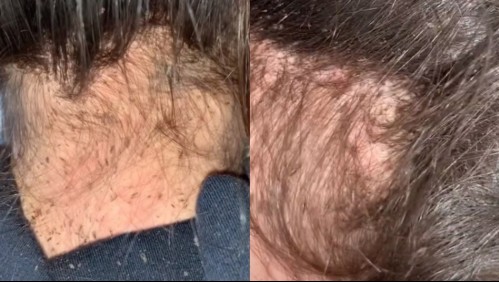 El impactante caso de una niña con pediculosis: Estuvo infestada por 6 meses y tardaron 9 horas en curarla