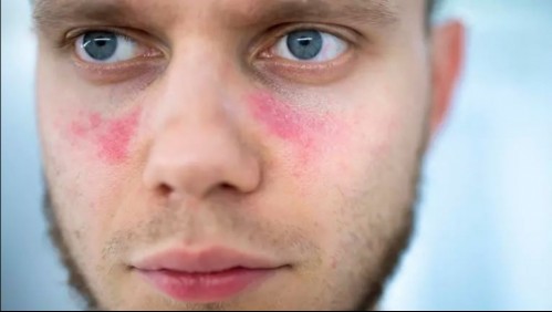 Día internacional del Lupus: Así puedes reconocer la enfermedad silenciosa que afecta principalmente a mujeres