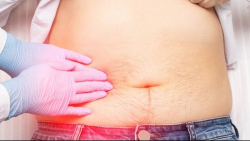 Cálculos en la vesícula: Estos son los síntomas que podrían alertar la presencia de 'piedras' en el órgano