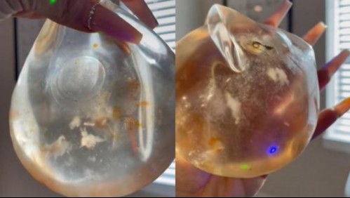 Enfermedad de los implantes mamarios: Esta es la condición que afectó a una famosa tiktoker