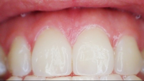 Lavarse los dientes no solo previene caries: Estudios relacionan el alzheimer con enfermedades en las encías
