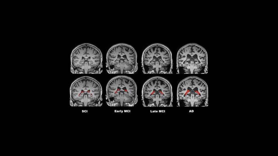 Se podría diagnosticar antes: Estudio relaciona el alzhéimer con cambios estructurales en partes del cerebro