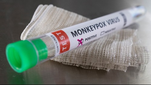 Reporte del estado de salud de chileno hospitalizado en Italia con viruela del mono: 'Nada de alarmismos'