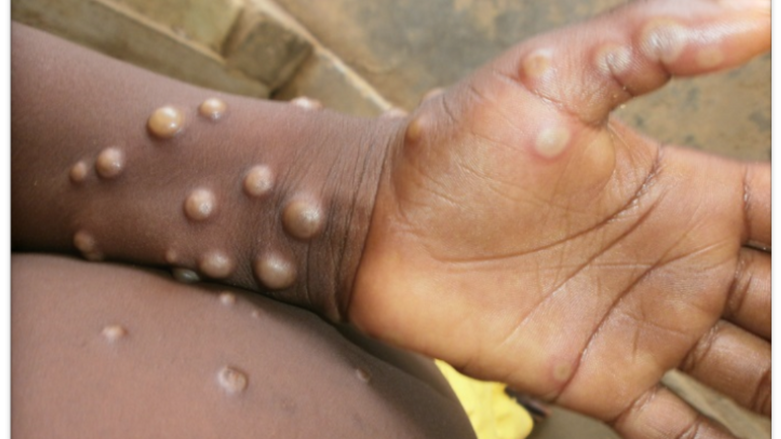 Lesiones en la piel que aparecen con la viruela del mono