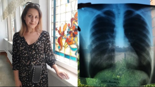 Fue al hospital por una neumonía y descubrió que tres de sus órganos estaban en el 'lado contrario' de su cuerpo