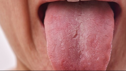 Podría parecer una simple herida: ¿Cuáles son los primeros síntomas del cáncer de lengua?