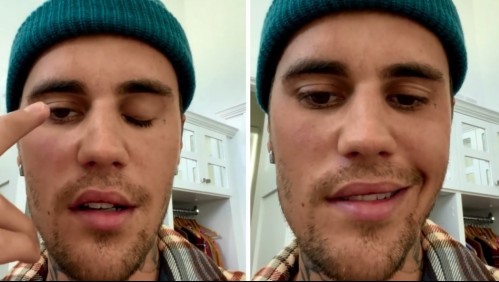 Tuvo una recaída: Esta es la enfermedad por la que Justin Bieber canceló su concierto en Chile