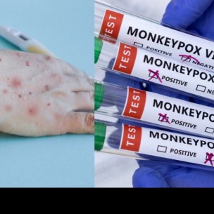 Estados Unidos intensifica vacunación contra la viruela del mono y dispone 56.000 dosis Estados Unidos intensifica vacunación contra la viruela del mono y dispone 56.000 dosis