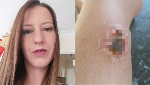 'Gritaba de dolor': Mujer estuvo a punto de perder la pierna tras ser mordida por una araña en un festival de música