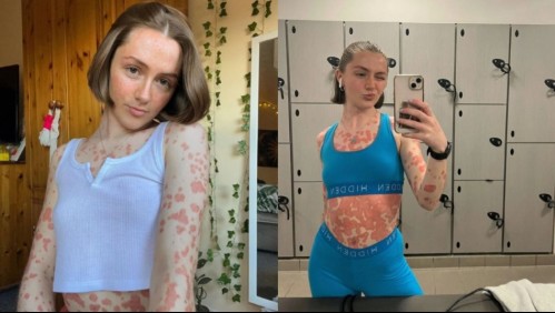 Joven enfermera pensó que solo tenía dolor de garganta pero luego le comenzaron a salir extrañas manchas en el cuerpo