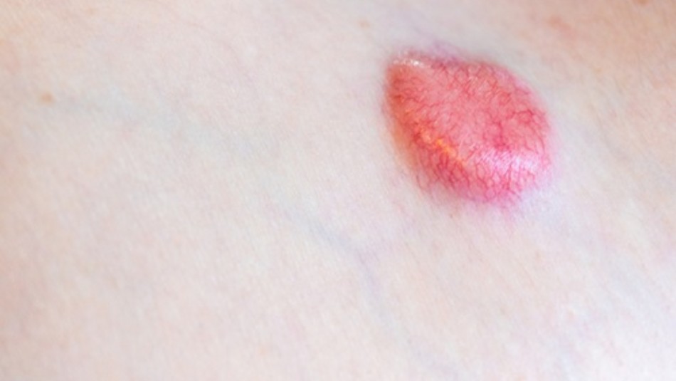 tratamiento cáncer de piel investigadoras chilenas crema
