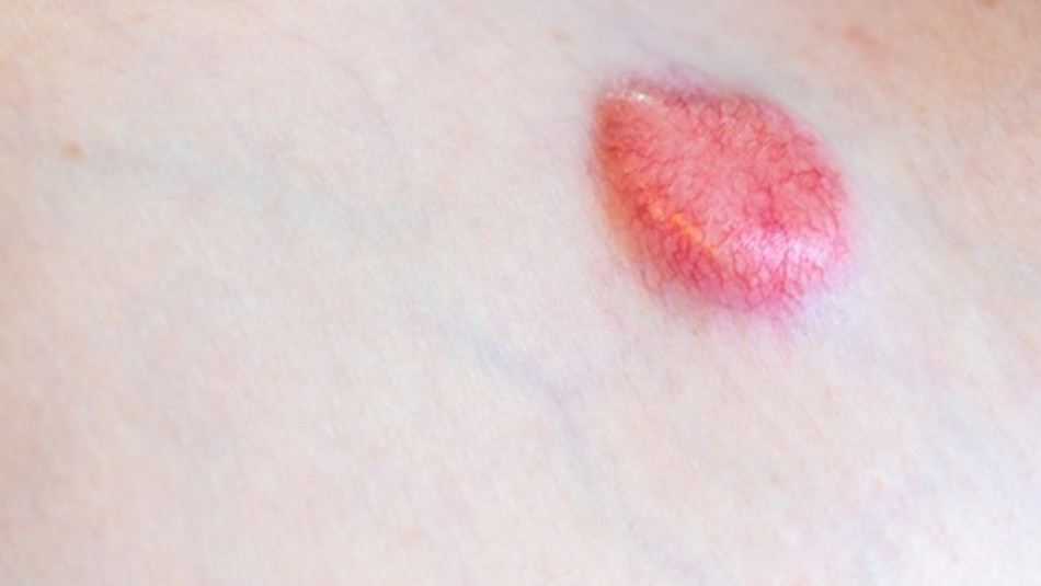 tratamiento-cancer-de-piel-investigadoras-chilenas-crema tratamiento cáncer de piel investigadoras chilenas crema