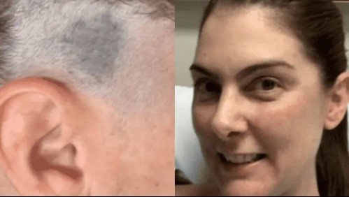 Fue a la peluquería por un corte de pelo y la estilista la salvó al descubrir una mancha azul en su cabeza