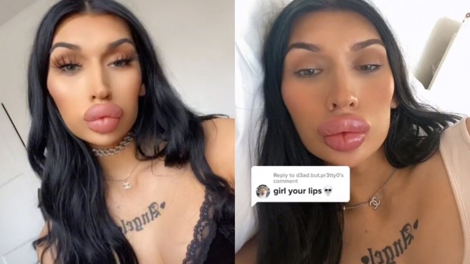 mujer-transgenero-se-inyecta-los-labios-cada-vez-que-terminan-con-ella Una mujer transgénero se inyecta los labios cada vez que terminan con ella.