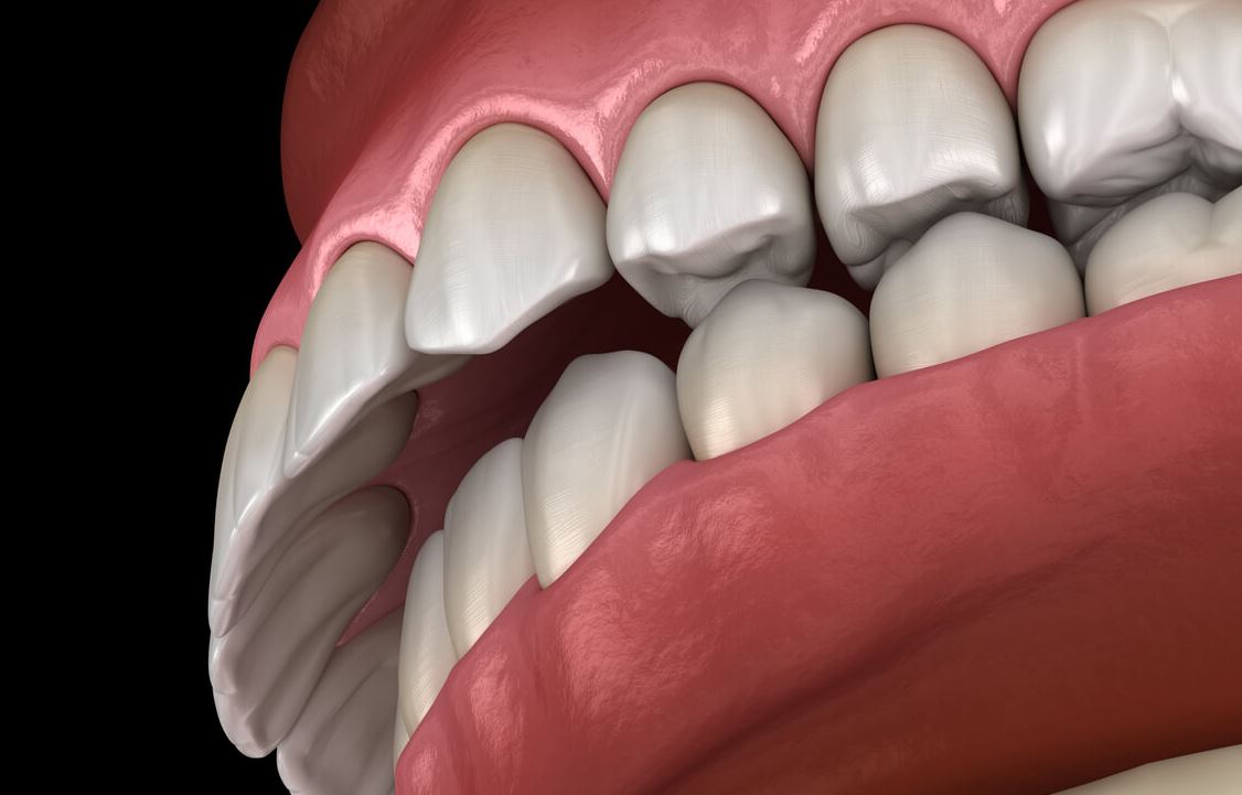 Ejemplo de dientes con protrusión. Créditos:tiiz.es