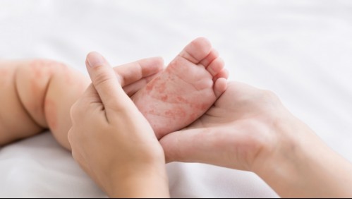 Hay un caso confirmado en Argentina: Estos son los síntomas del contagioso sarampión