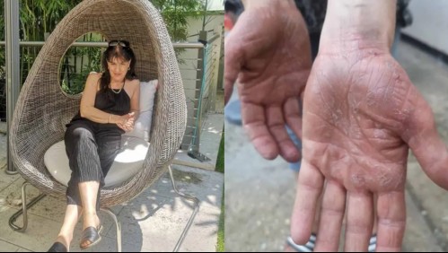 Estuvo dos años con una extraña picazón en sus manos y los doctores le entregaron una devastadora noticia