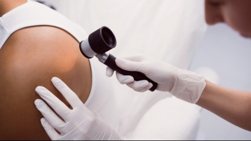 'Pensaba que no me podía pasar': Fue a revisarse un lunar y le dieron duro diagnóstico