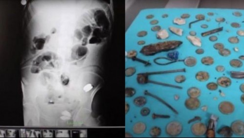 Hombre va al médico por un fuerte dolor de abdomen y le encuentran más de 200 objetos en el estómago