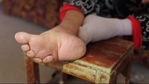 ¿Qué son los pies de loto?: La milenaria y dolorosa tradición a la que eran sometidas las mujeres en China