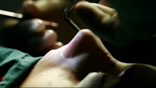 'Rinoplastia casera': Hombre terminó en la urgencia al intentar operarse la nariz siguiendo un tutorial en Internet