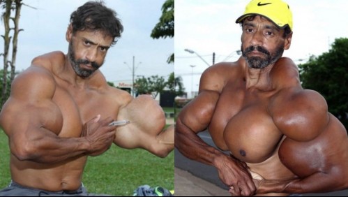Muere de un paro cardíaco el 'Hulk brasileño' tras inyectarse aceite por años para aumentar sus músculos