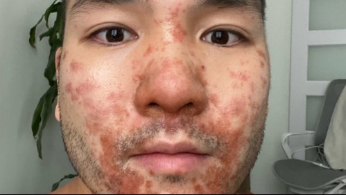Creyó que tenía dermatitis pero en realidad era viruela del mono: 'Todo comenzó a empeorar rápidamente'
