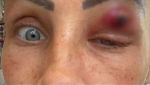 Mujer creyó que tenía un grano en su párpado pero terminó expulsando un parásito: 'No podía ver nada'