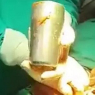 Los médicos lo operaron por un fuerte dolor y terminaron sacando una copa de acero de su estómago Los médicos lo operaron por un fuerte dolor y terminaron sacando una copa de acero de su estómago