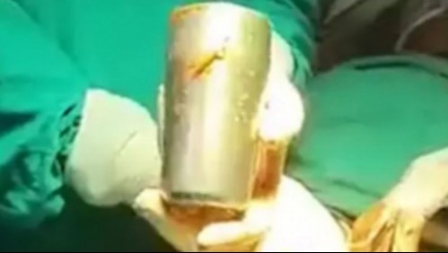 Los médicos lo operaron por un fuerte dolor y terminaron sacando una copa de acero de su estómago