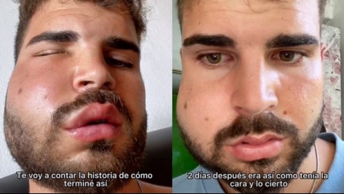 'Amaneció con la cara deformada': Joven fue al dentista por un fuerte dolor de muela y quedó irreconocible