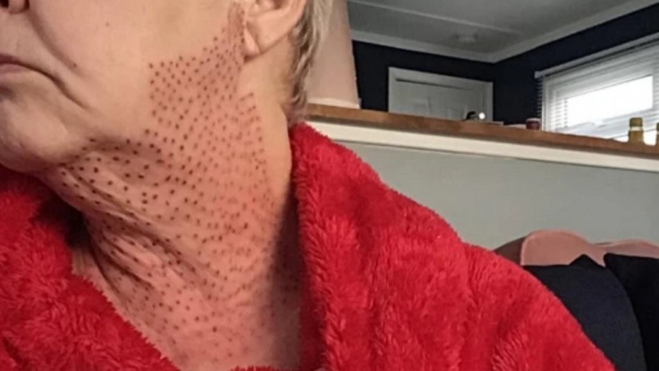 Una mujer terminó con cicatrices en su cuello tras una intervención estética.