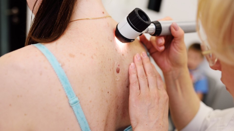 cancer de piel sintomas melanoma