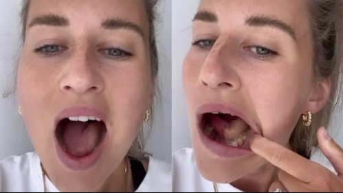 Tenía úlceras en la boca, pensó que se trataba de estrés o resaca, pero en realidad era una grave enfermedad