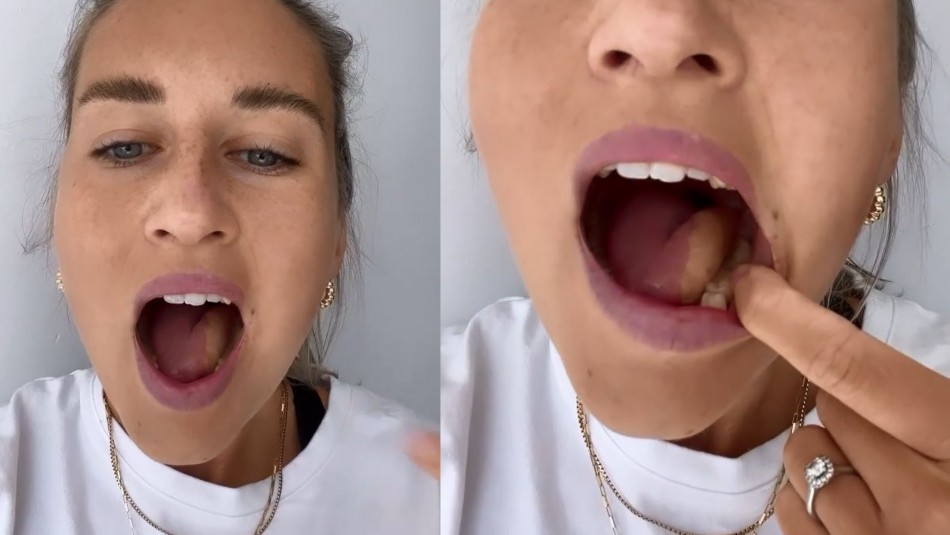 heridas cancer ulceras boca lengua
