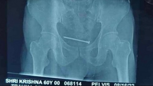 Tenía un 'dolor insoportable' y los doctores terminaron encontrando un clavo de 10 centímetros en su vejiga