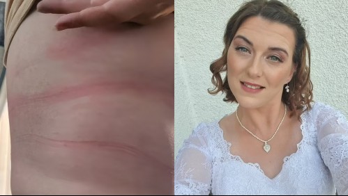 El drama de una mujer que tuvo una fuerte reacción alérgica en su matrimonio: 'Tampoco puedo usar mi anillo'