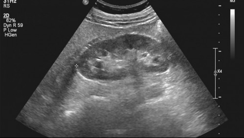 Fue a realizarse una ecografía para después operarse y los doctores descubrieron que tenía 3 riñones