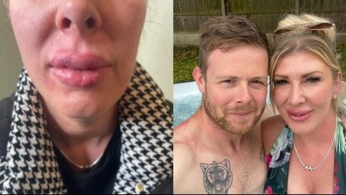 Fue a un centro de estética para completar su relleno de labios y afirmó que quedaron 'como hot-dogs'