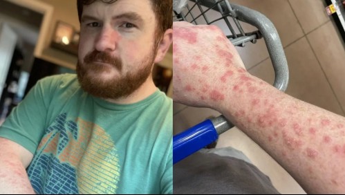 'Esto no es contagioso': El drama de un hombre a quien le confunden su enfermedad de la piel con viruela del mono