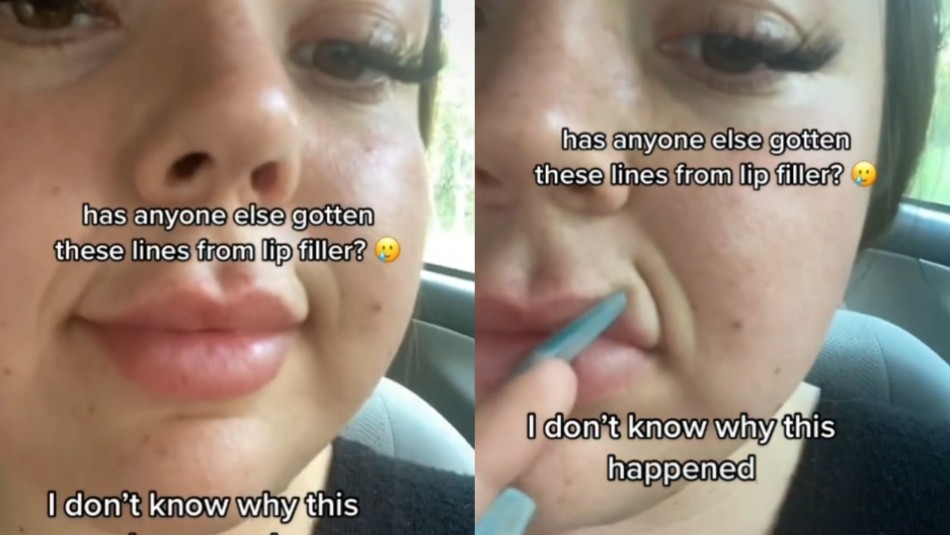 Una joven se inyectó relleno de labios y quedó con extrañas líneas en su rostro.
