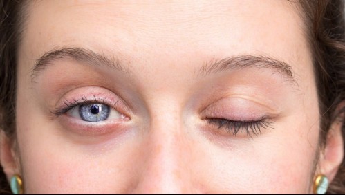 Estas son las claves que te ayudarán a reconocer si tienes una parálisis facial