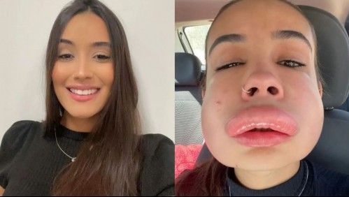 'Dios mío, ¿qué hice?': Joven estudiante estuvo a punto de morir tras una fallida sesión de relleno de labios